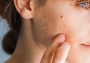 Face medical’s guide to understanding acne
