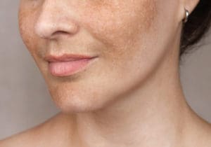 Face Medical - Summer skin damage